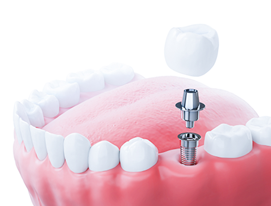 抜歯即時埋入・即時荷重